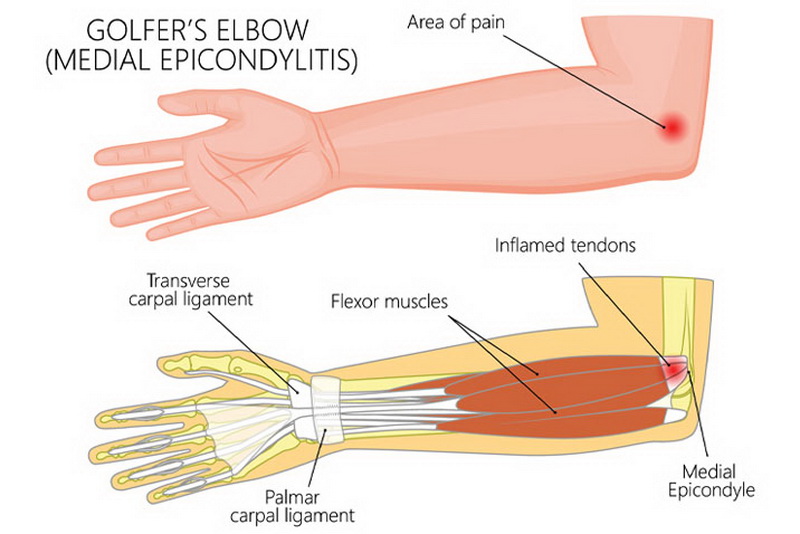 What is the best treatment for golfers elbow