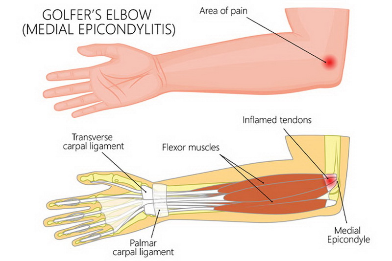 Яке найкраще лікування ліктя гольфіста