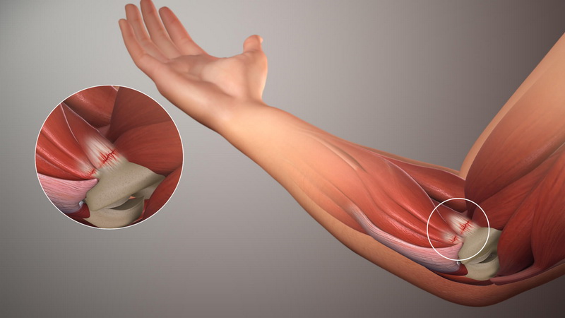 What is the fastest way to cure golfers elbow